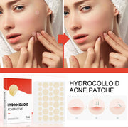 Patchs hydrocolloïdes anti-imperfections 144 pièces